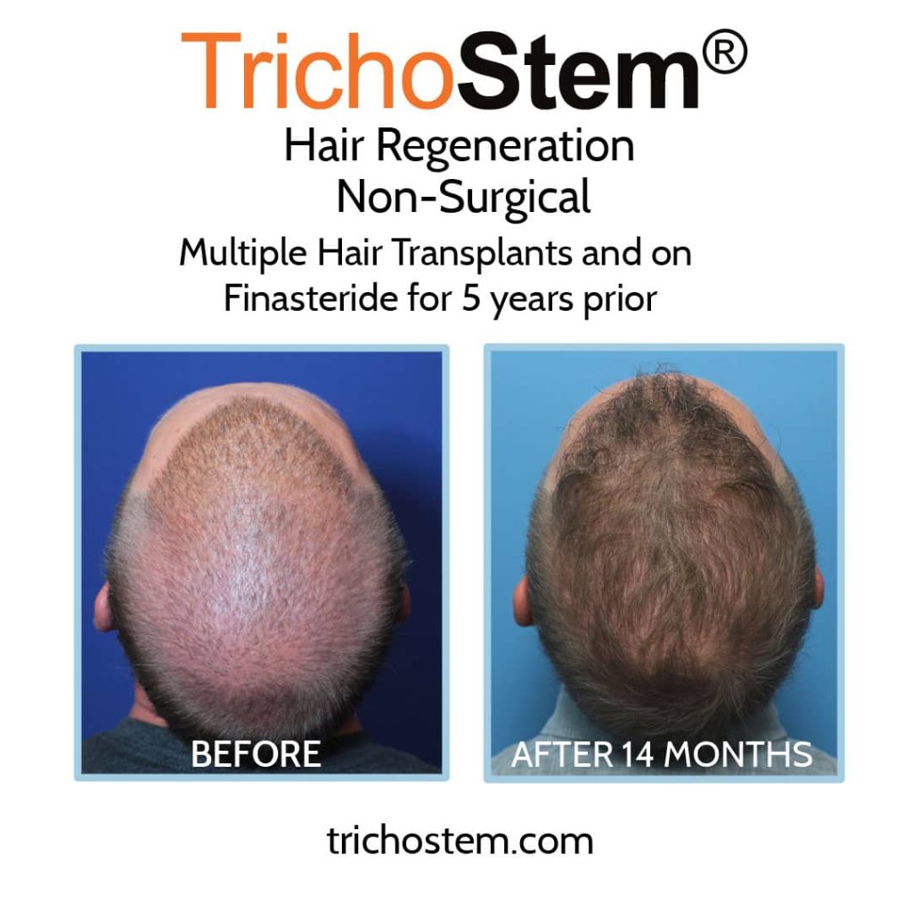 Hair Regeneration before and after results. Multiple hair transplants and on finasteride before Hair Rgeneration injection