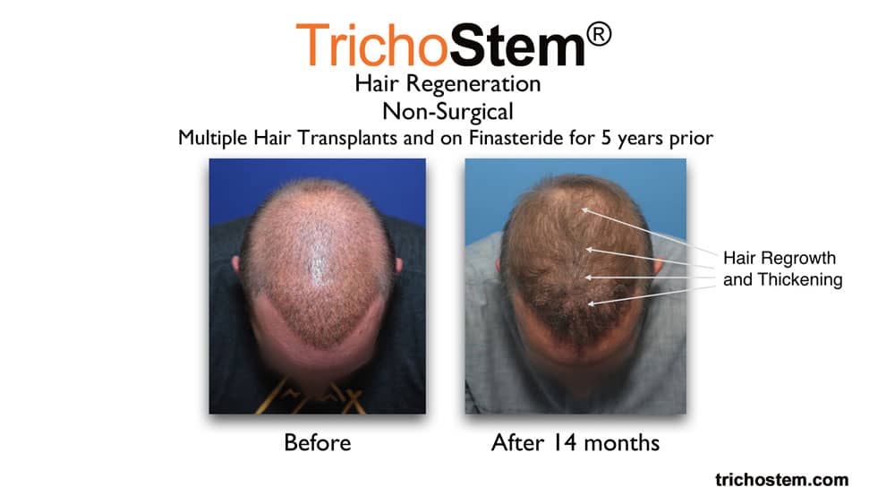 hair regeneration for multiple hair transplants before and after