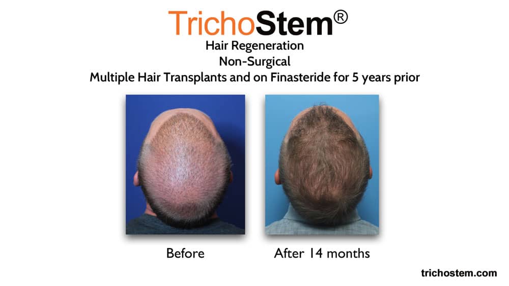 Trichostem Hair Regeneration before and after results. Patient had multiple hair transplants and on finasteride before Hair Regeneration treatment