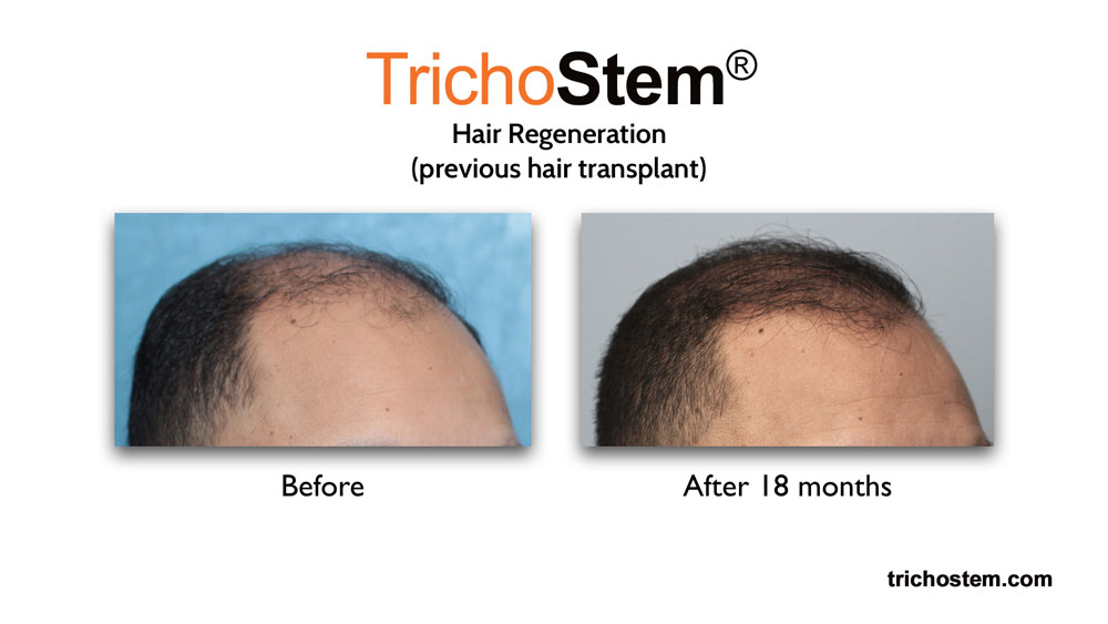 hair regeneration before and after 18 months results - fixing a failed hair transplant