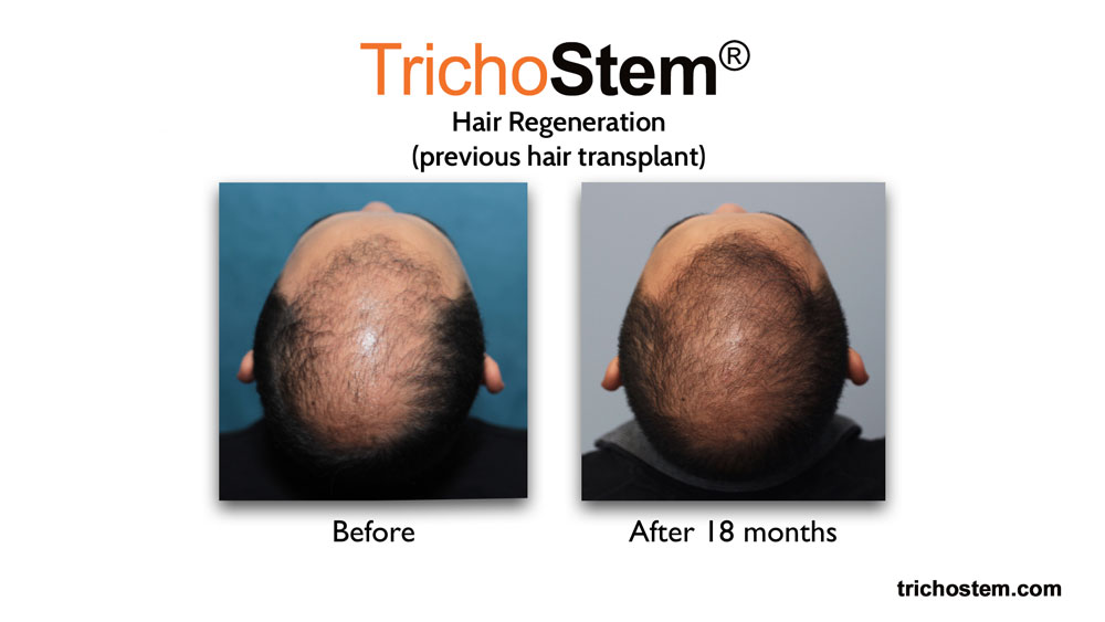 hair regeneration for previous hair transplant before and after