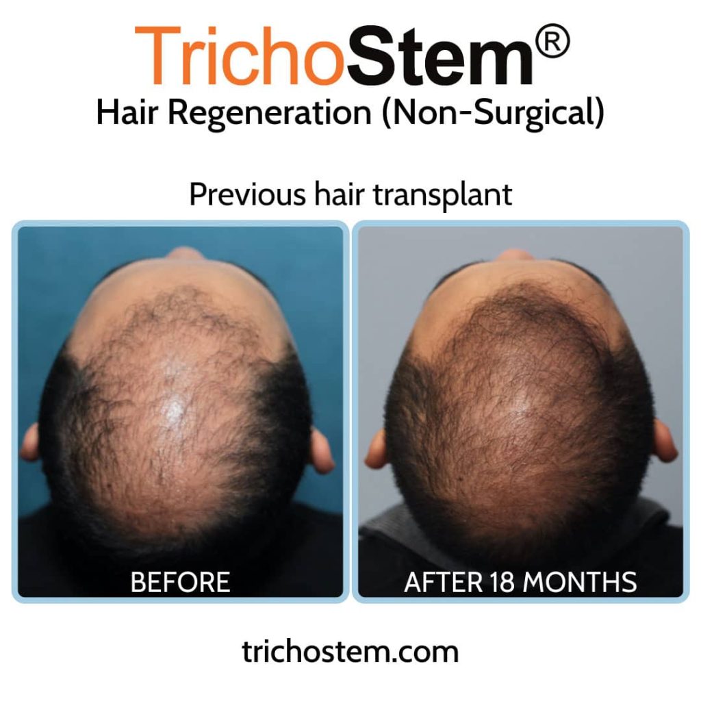 hair regeneration for failed hair transplant before and after