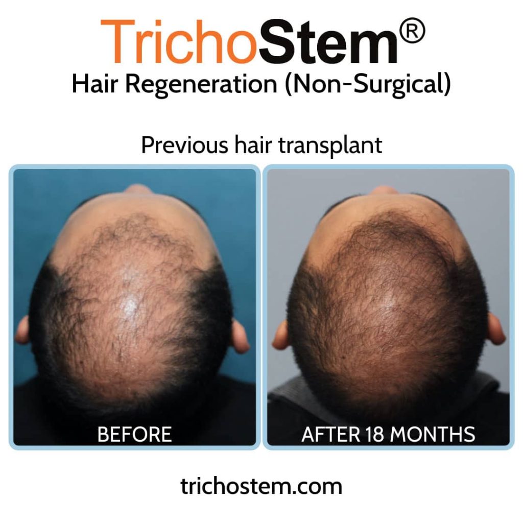 Hair Transplant Gone Wrong  A Look at the Biggest Risks