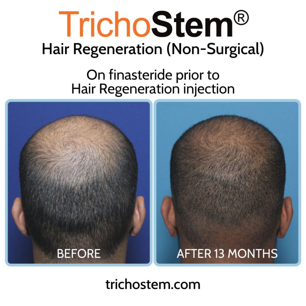 Hair Regeneration performed after patient was on finasteride before and after 13 months