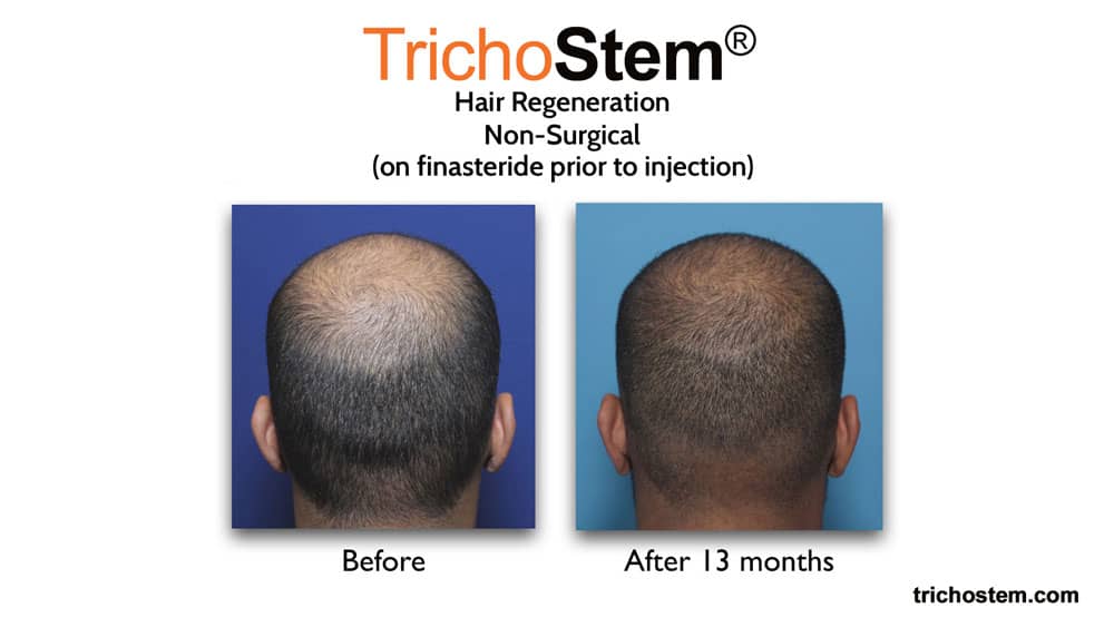 Trichostem Hair Regeneration patient was on finasteride before and after 13 months