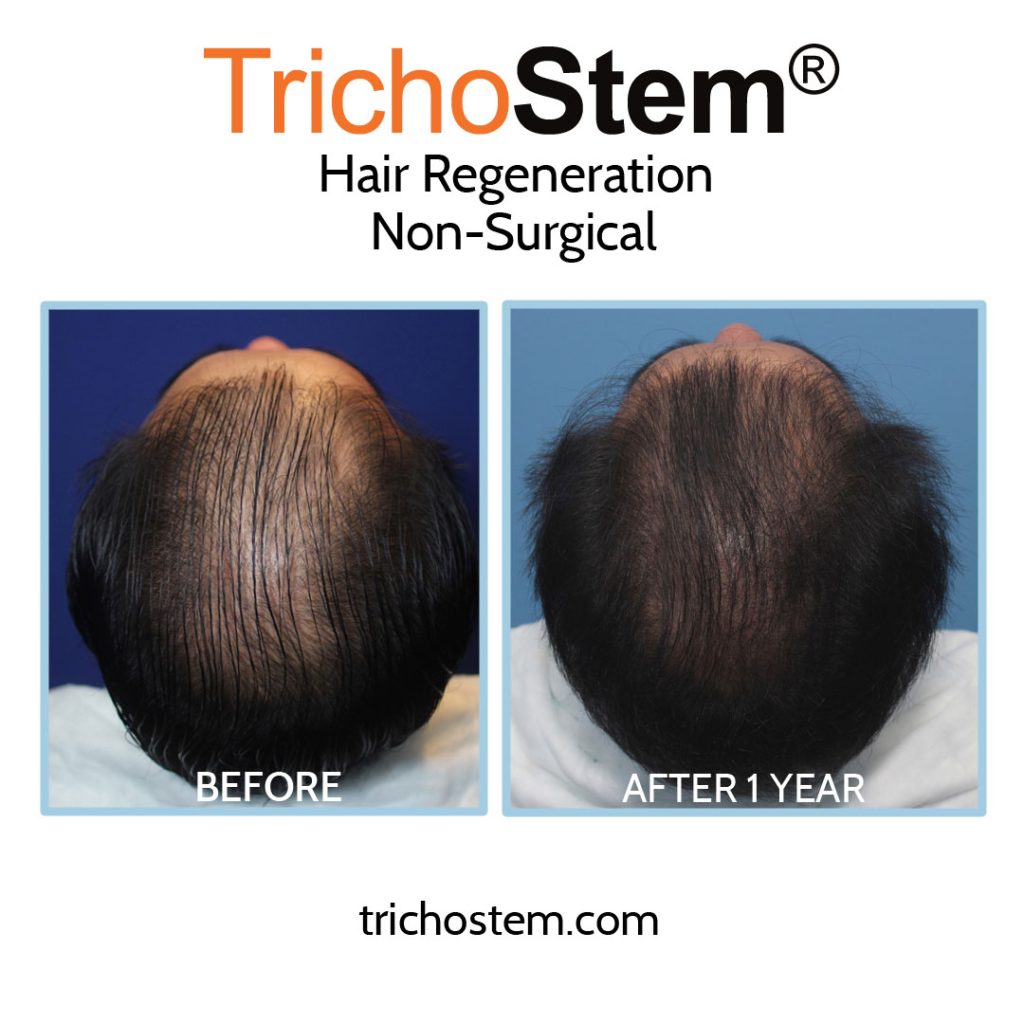 Hair regeneration before and after - fixing failed hair transplant