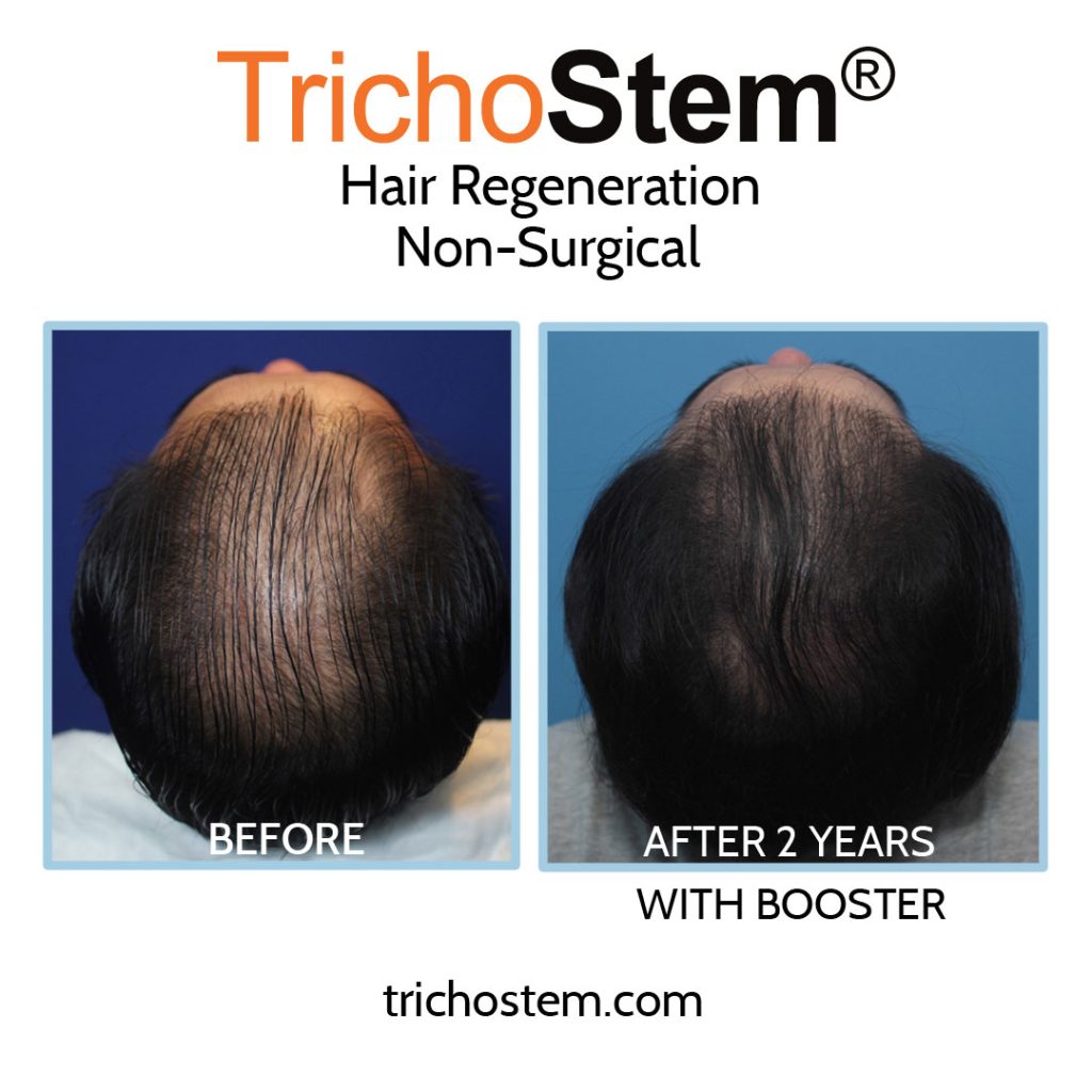 hair regeneration before and after booster