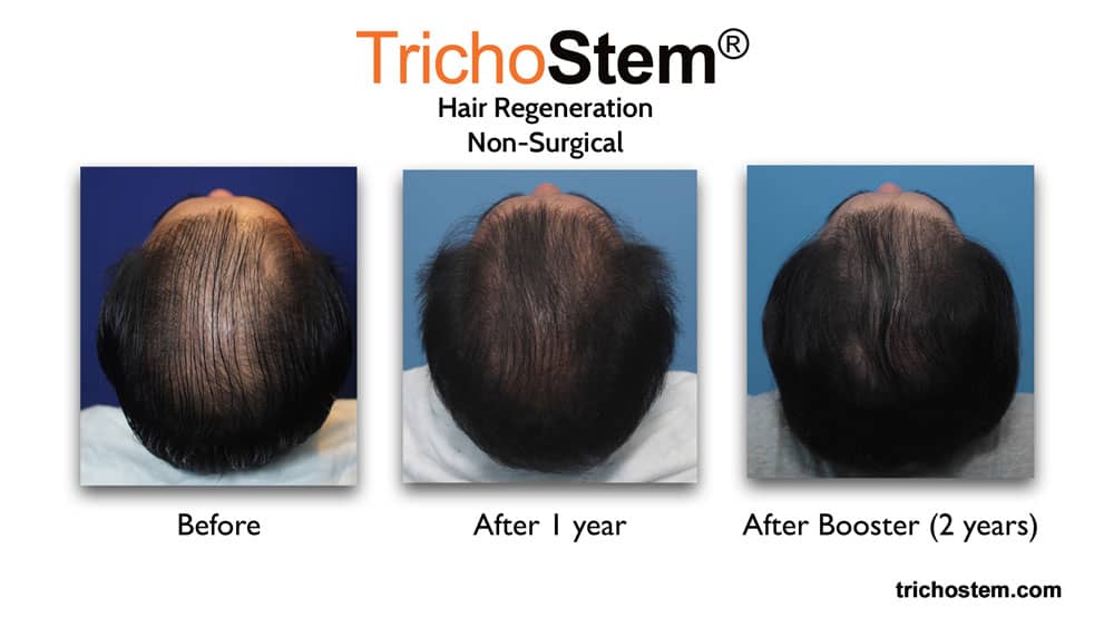 hair regeneration before and after with booster - fixing failed hair transplant