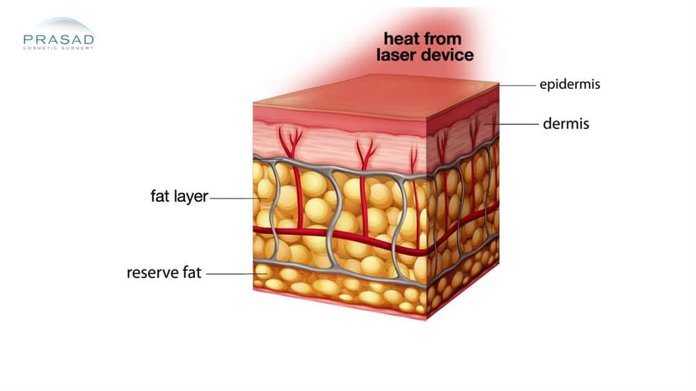 laser volume loss illustration