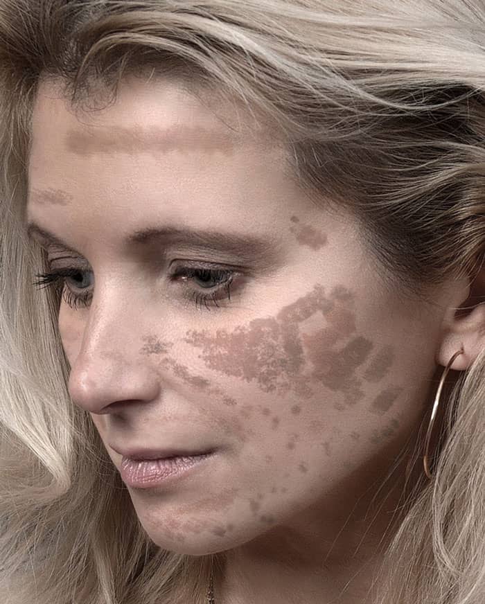 laser damaged skin *photoshop simulation