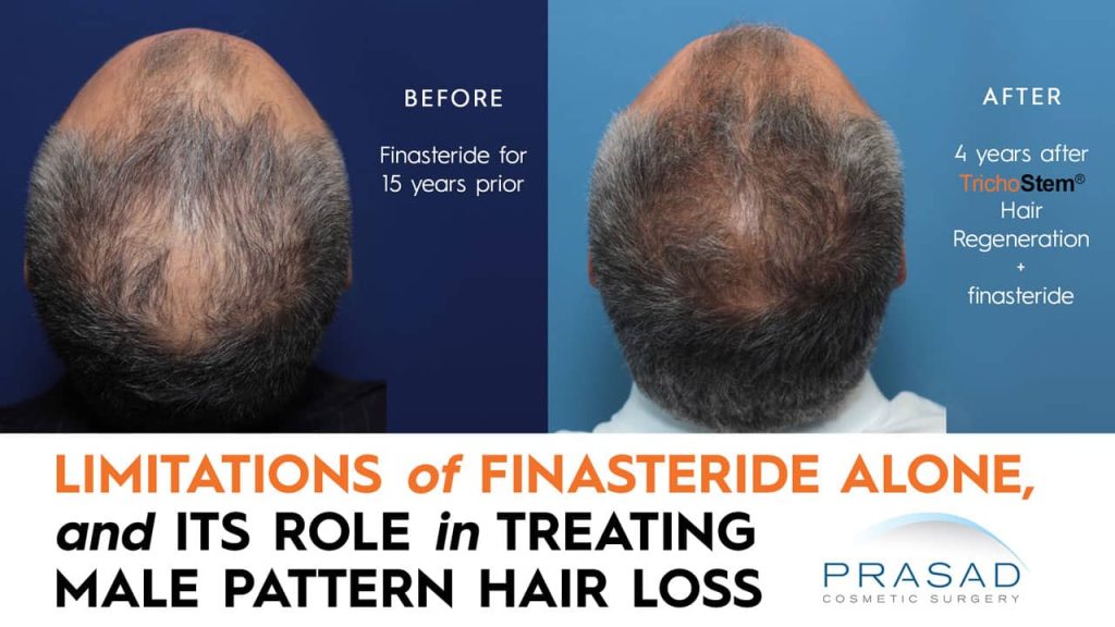Limitations of finasteride alone - why finasteride is not working