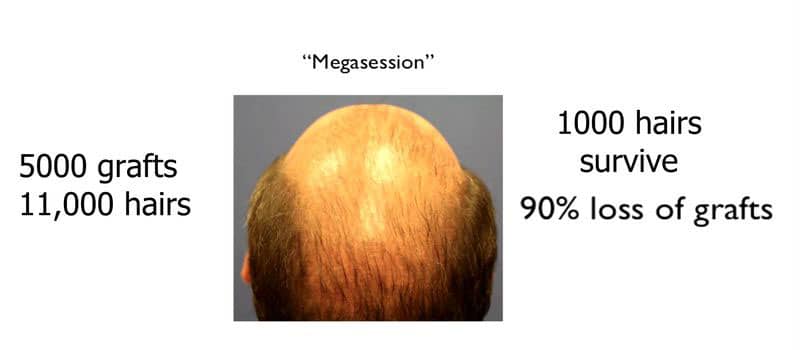 megasession hair transplant graft survival