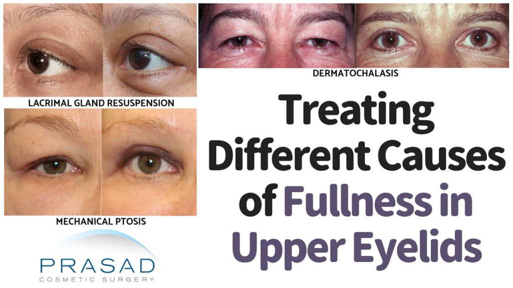 Treating different causes of heavy lidded eyes