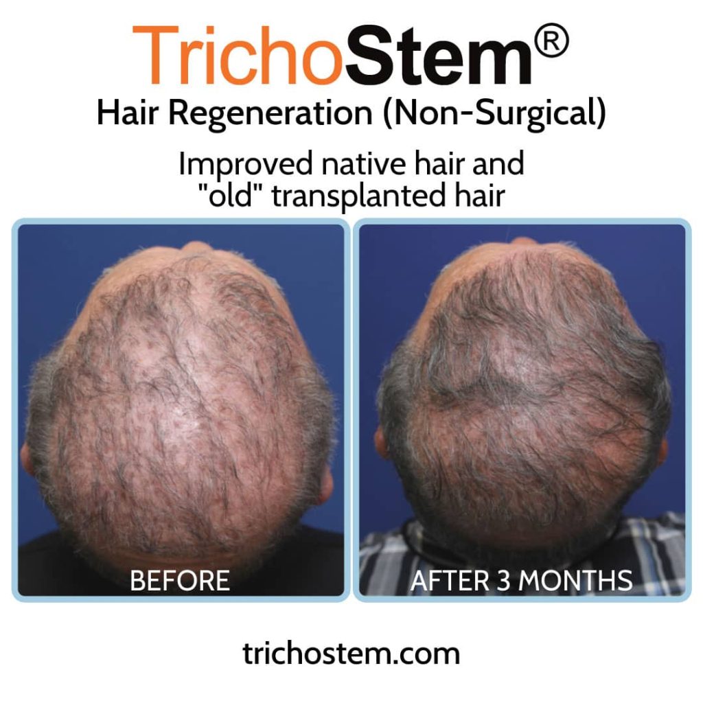 hair regeneration for bad hair transplant before and after 3 months