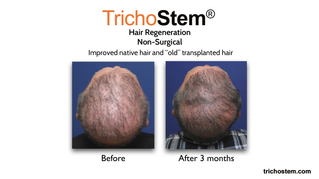 hair regeneration for bad hair transplant before and after