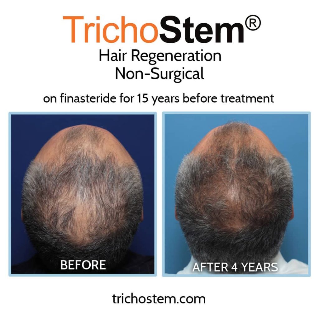 Trichostem Hair Regeneration before and after 4 years. Finasteride alone is not working on male with advance hair loss.