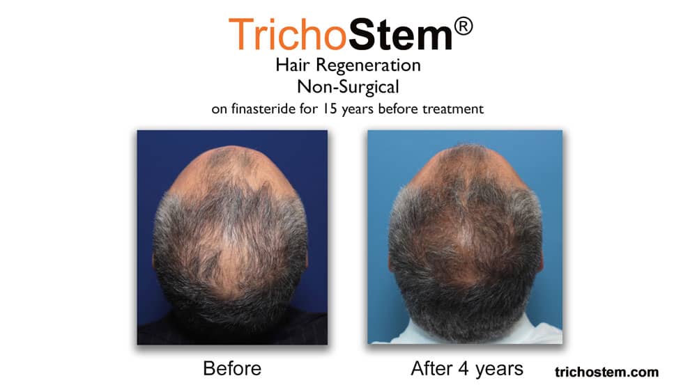 Trichostem Hair Regeneration before and after results. Finasteride alone isn’t working on male with advance hair loss.