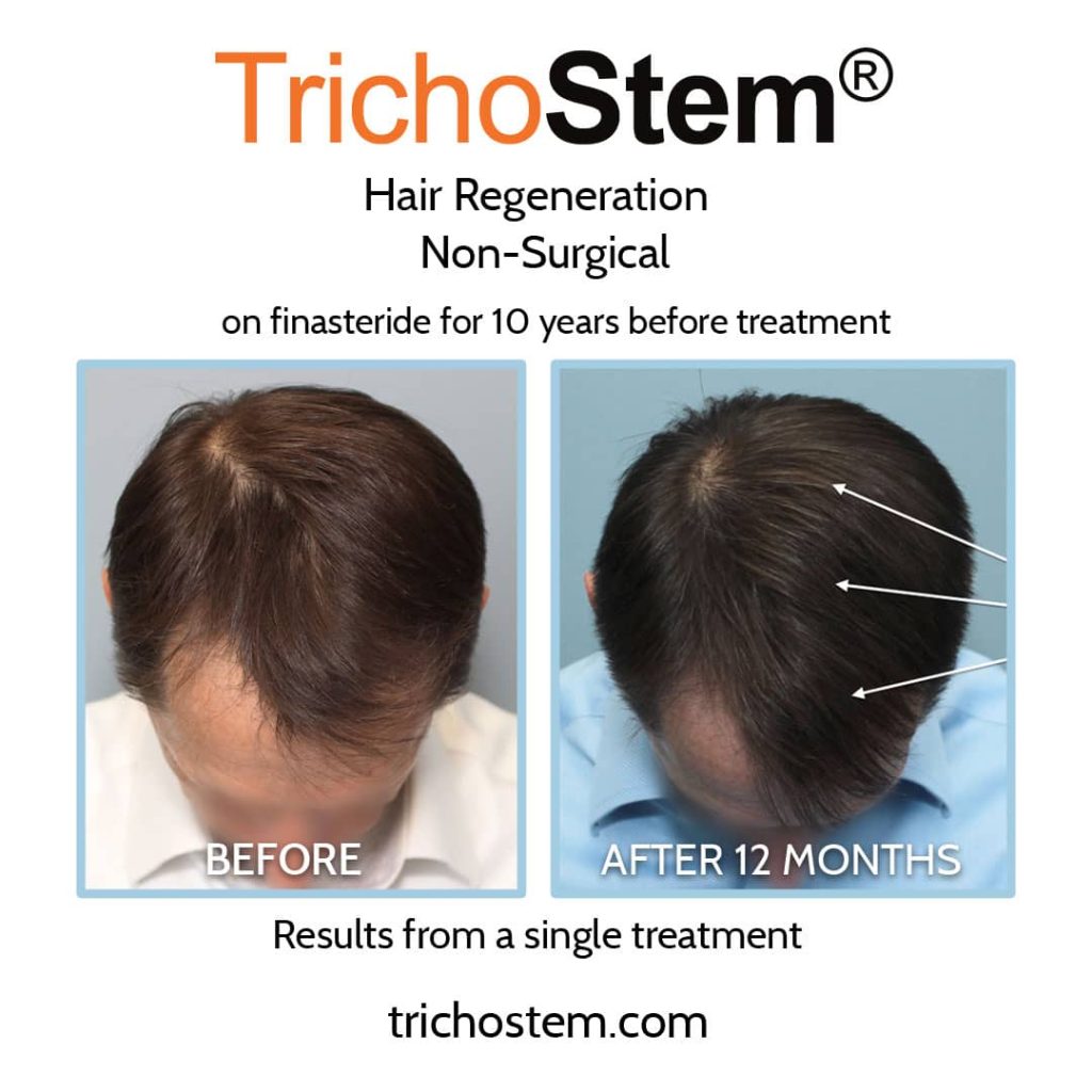 What to do if finasteride is not working – Trichostem Hair Regeneration results before and after 12 months