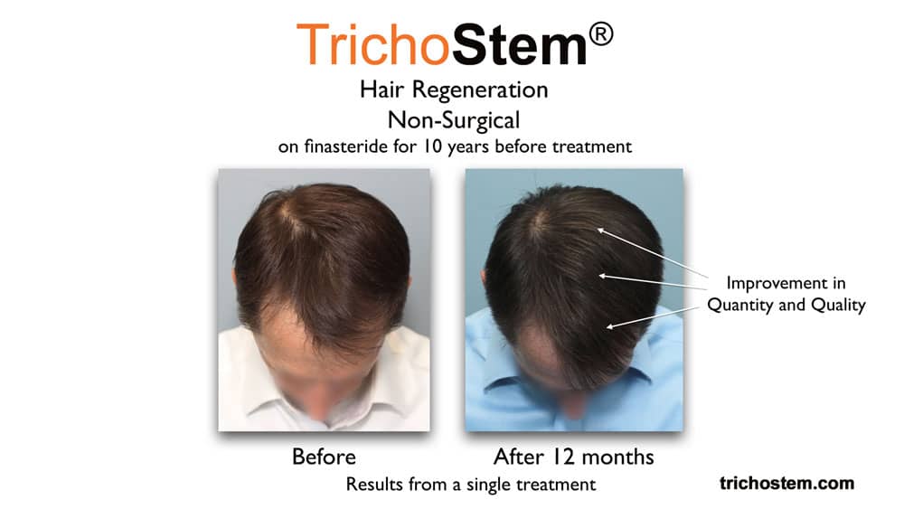 What to do if finasteride is not working – Trichostem Hair Regeneration results before and after. Male patient previously on finasteride