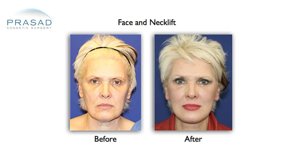 deep plane facelift before and after