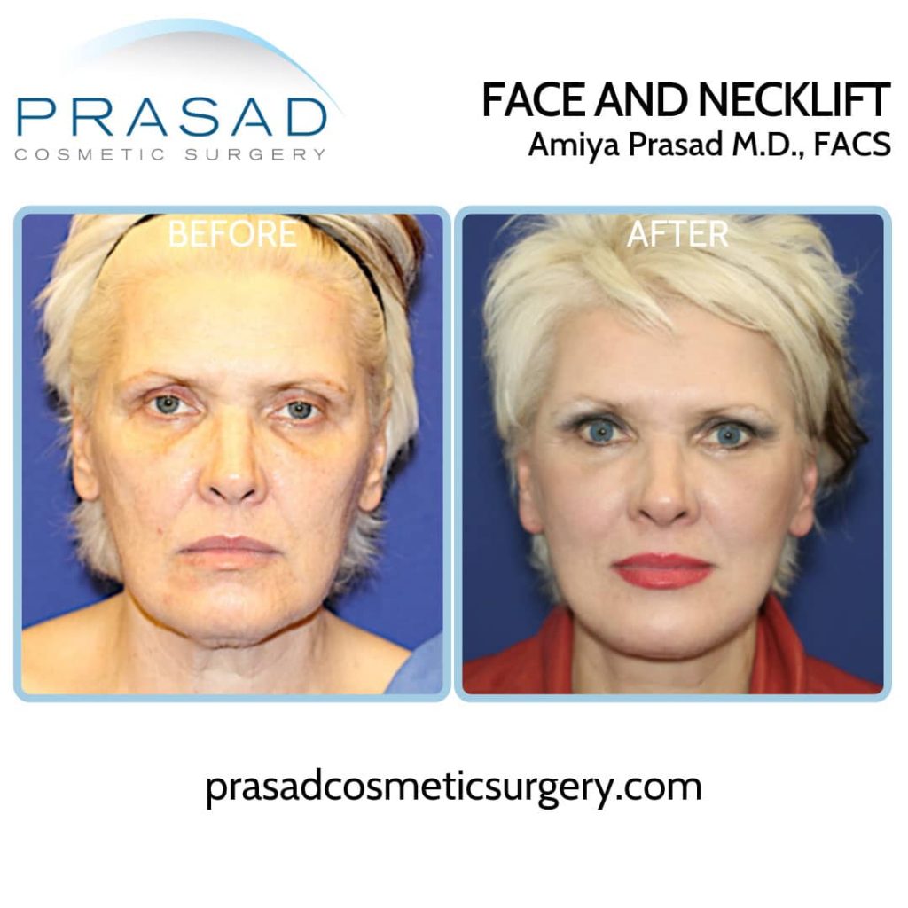 deep plane facelift and neck lift before and after