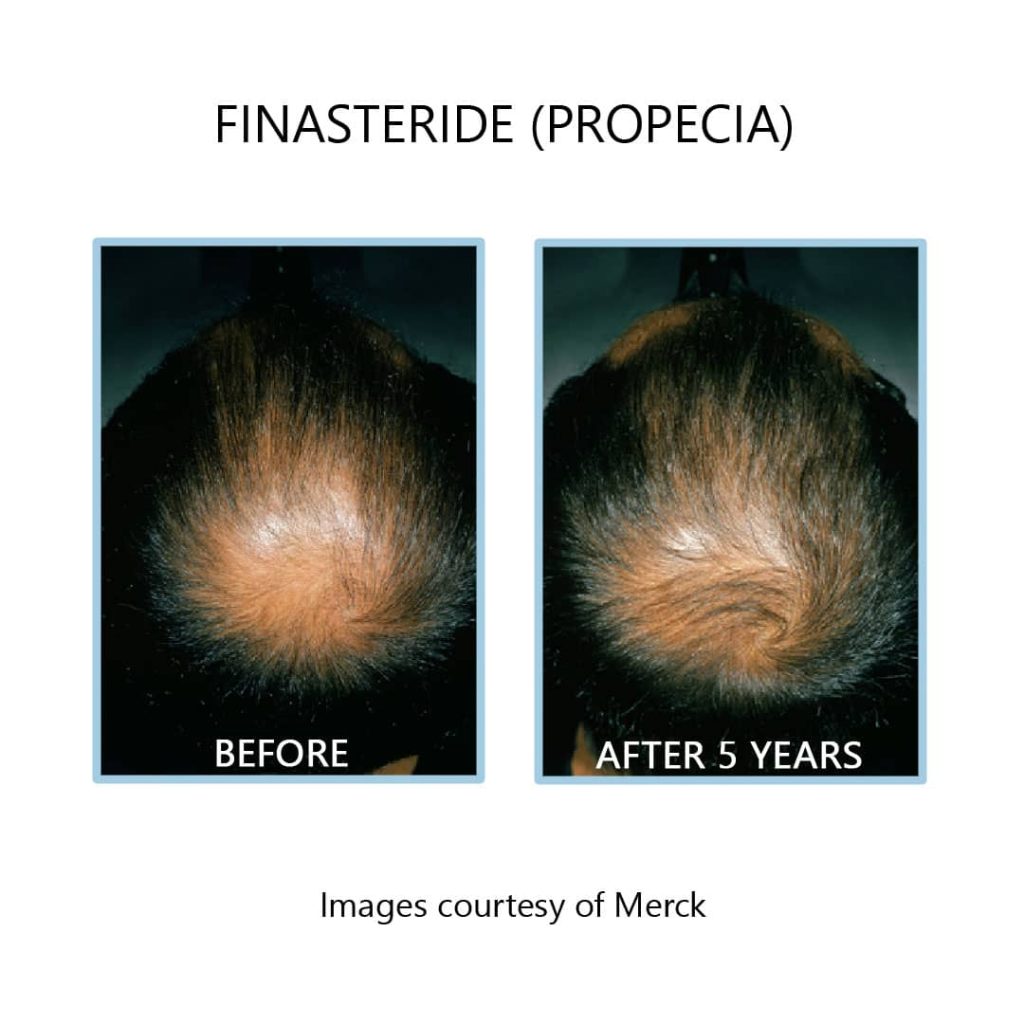 finasteride before after results 5 years