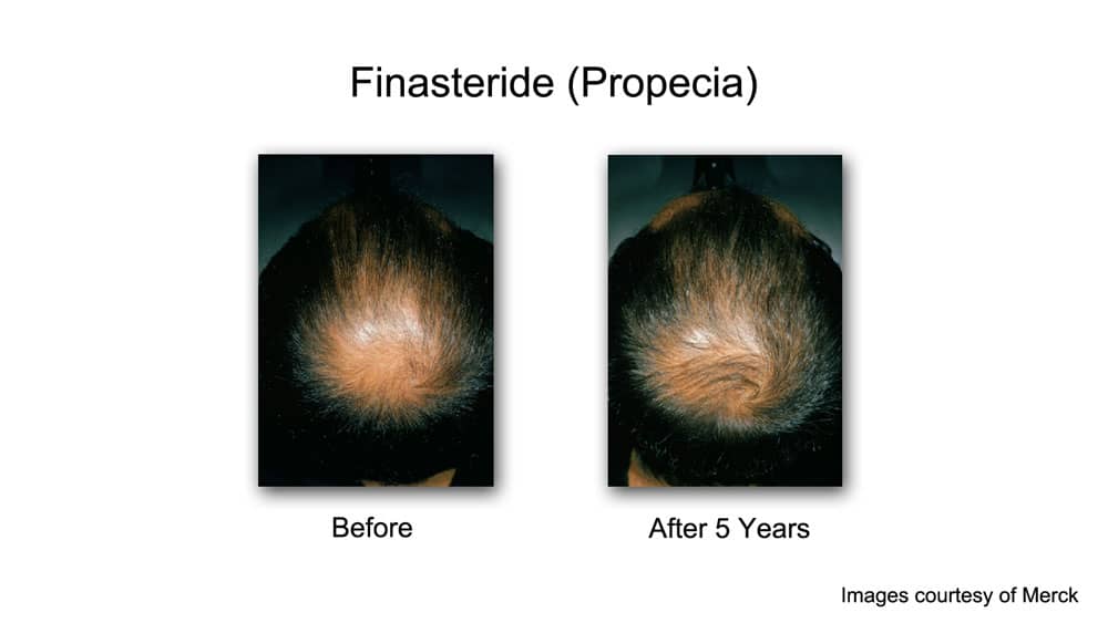 finasteride before and after crown