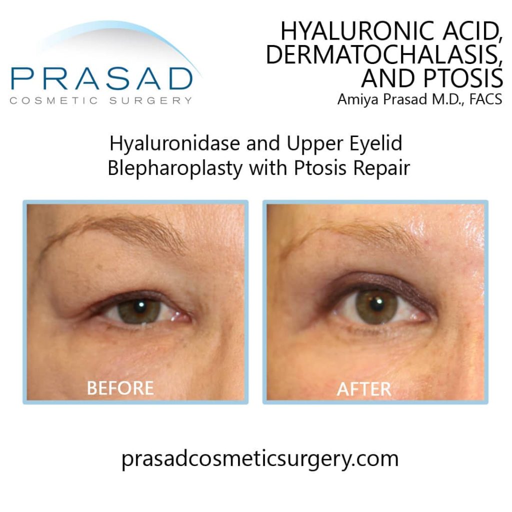 Ptosis before and after surgery. Possible cause of heavy lidded eyes