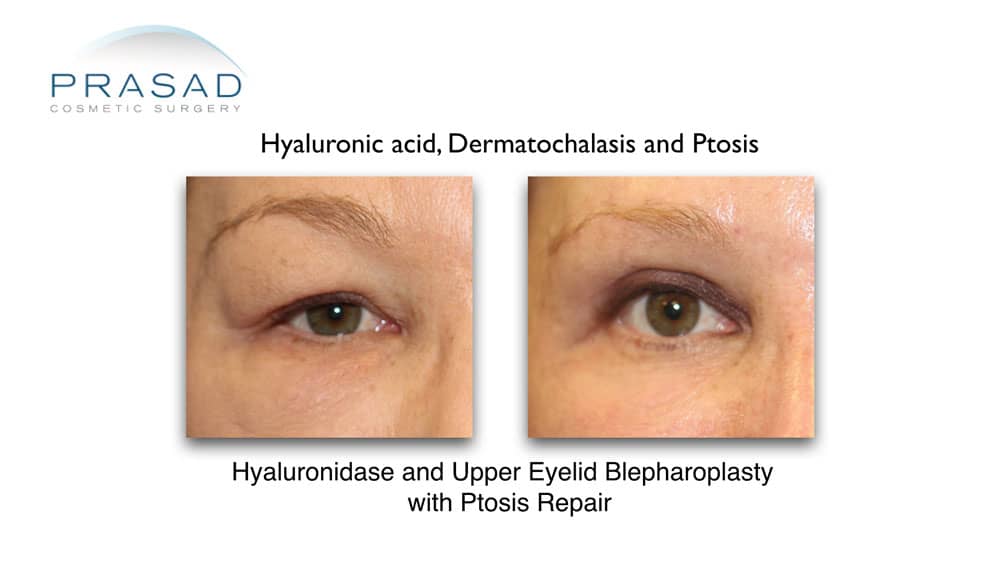 Upper eyelid blepharoplasty before and after. Possible cause of heavy lidded eyes