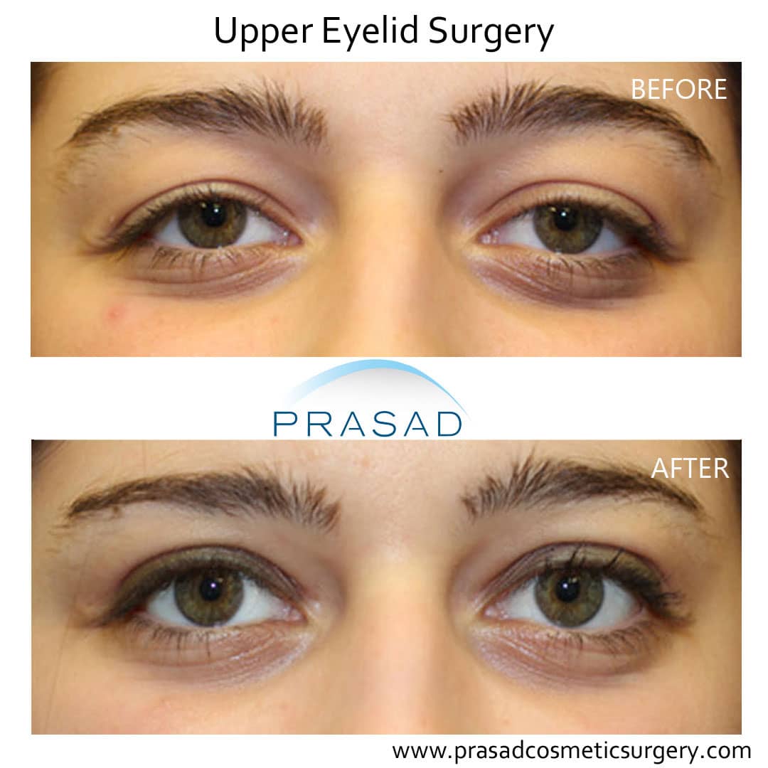 upper eyelid surgery before and after young female for heavy lidded eyes
