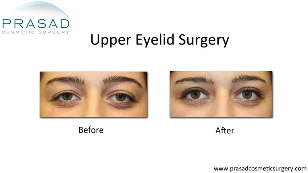 upper blepharoplasty before and after for heavy lidded eyes