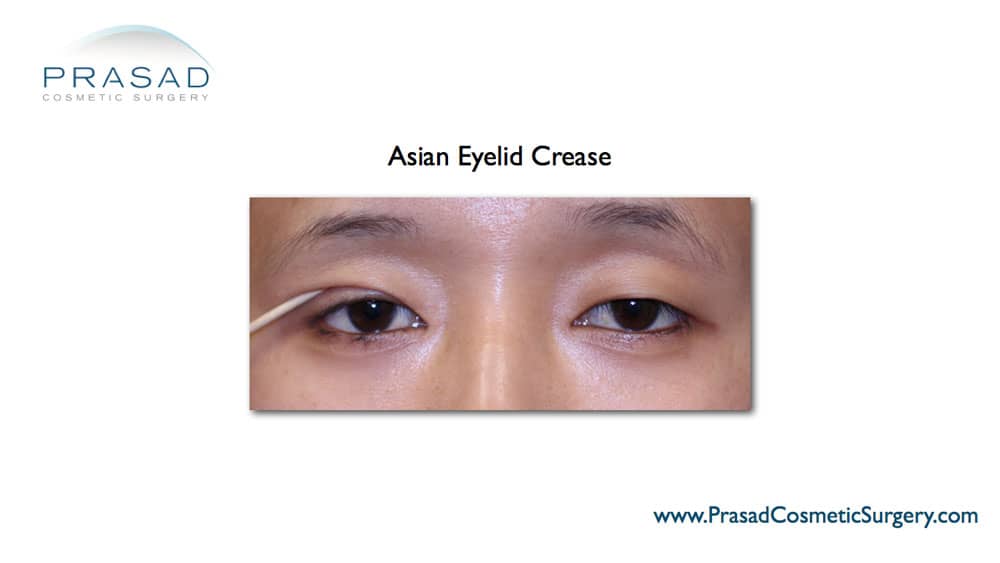 how Asian eyelid crease is created