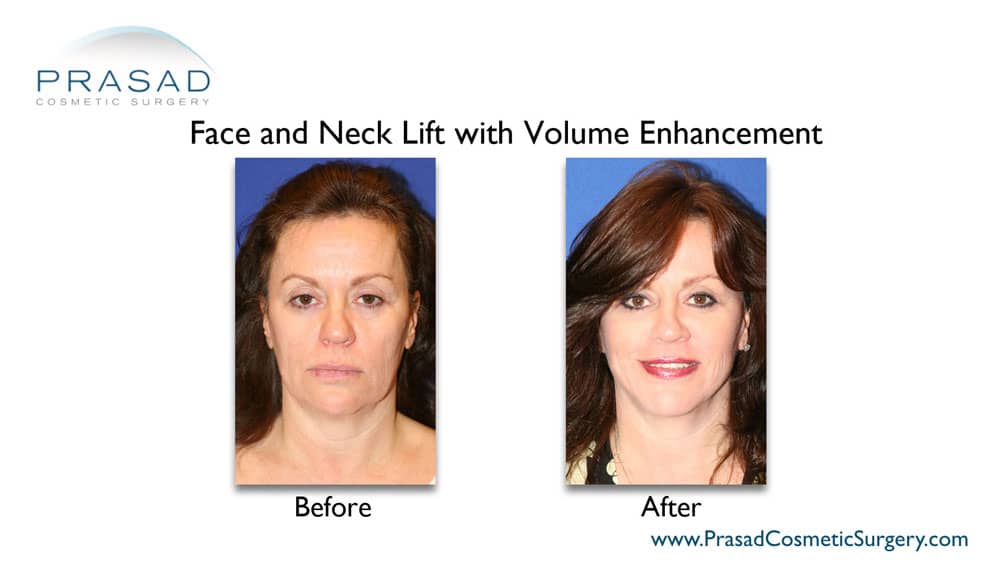 facelift and neck lift before and after with volume enhancement