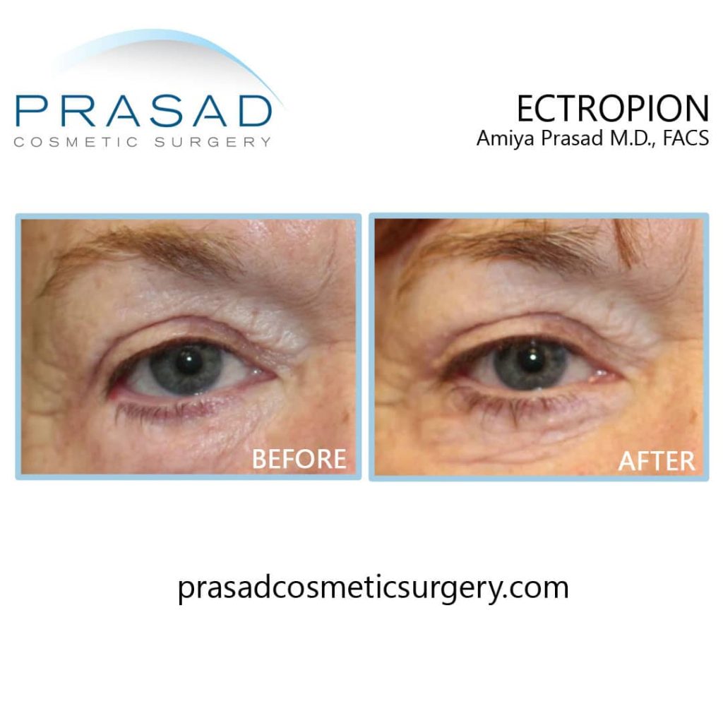 ectropion before and after eyelid surgery gone wrong