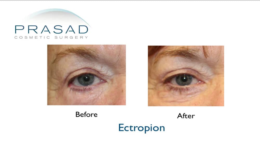 ectropion before and after (eye bag surgery gone wrong)