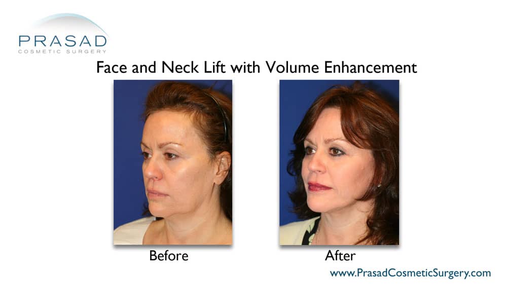 face and neck lift before and after surgery with volume enhancement