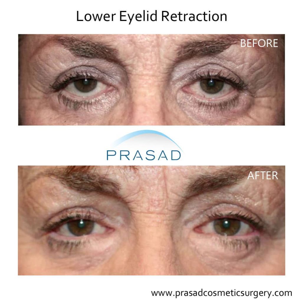eyelid surgery gone wrong fixed by Dr. Prasad before and after