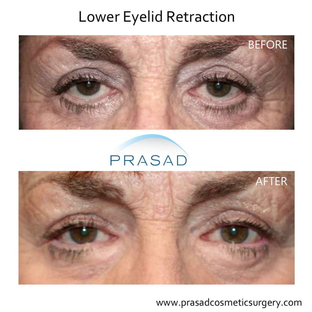 Eyelid Surgery Houston TX  Blepharoplasty Surgeon  Funk Facial Plastic  Surgery