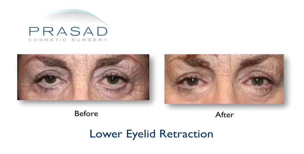 lower eyelid retraction (eye bag surgery gone wrong) before and after