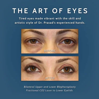 before and after upper and lower eyelid surgery and laser for lower eyelids
