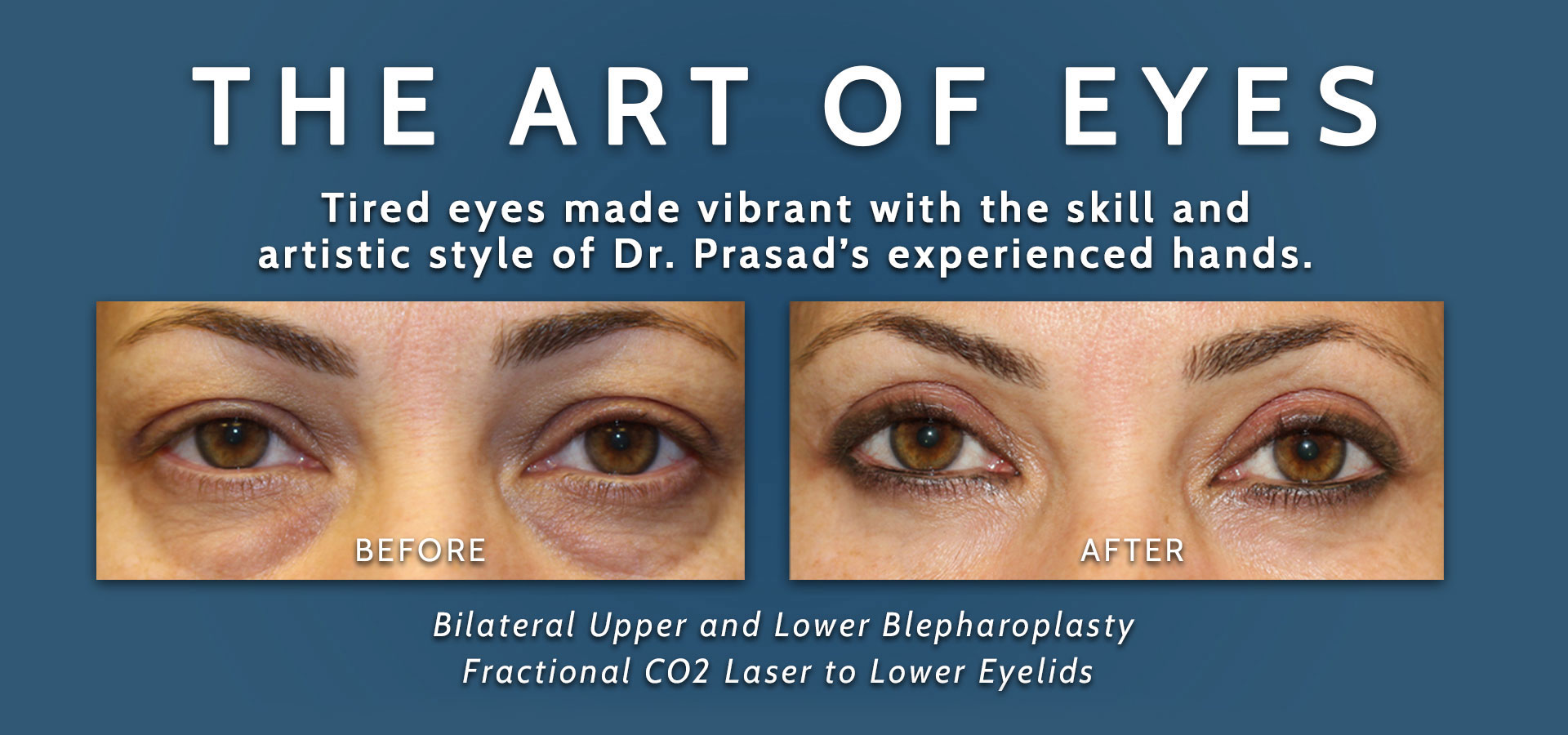 the art of eyes - before and after upper and lower blepharoplasty and laser under eyes