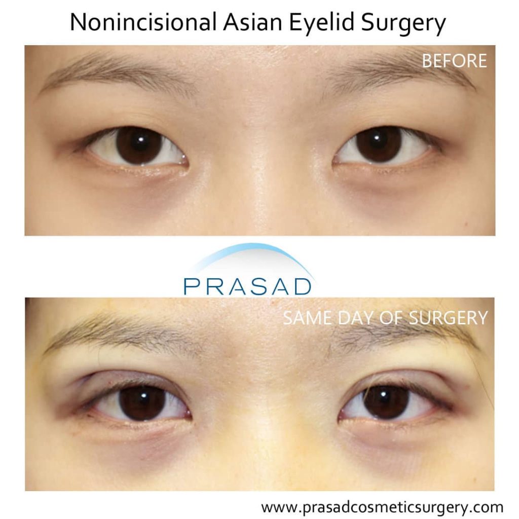 double eyelid surgery before and after same day of surgery