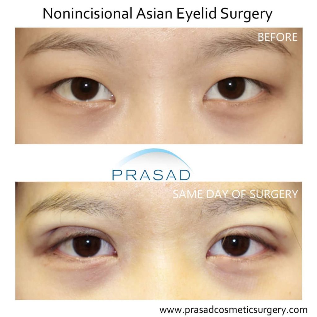 Appearance of a high double eyelid fold. The surgically created