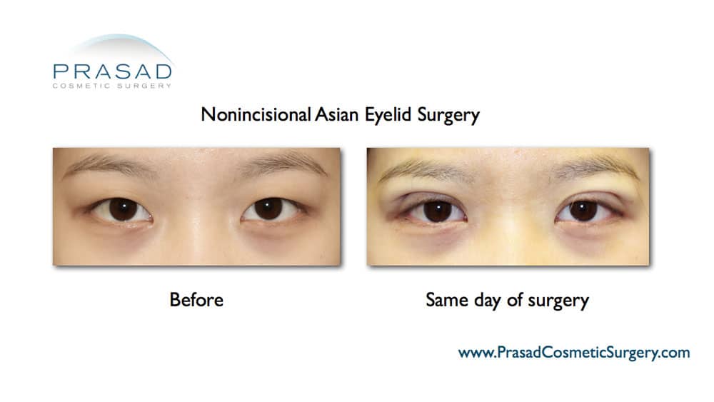 Asian double eyelid surgery before and after the same day of surgery recovery