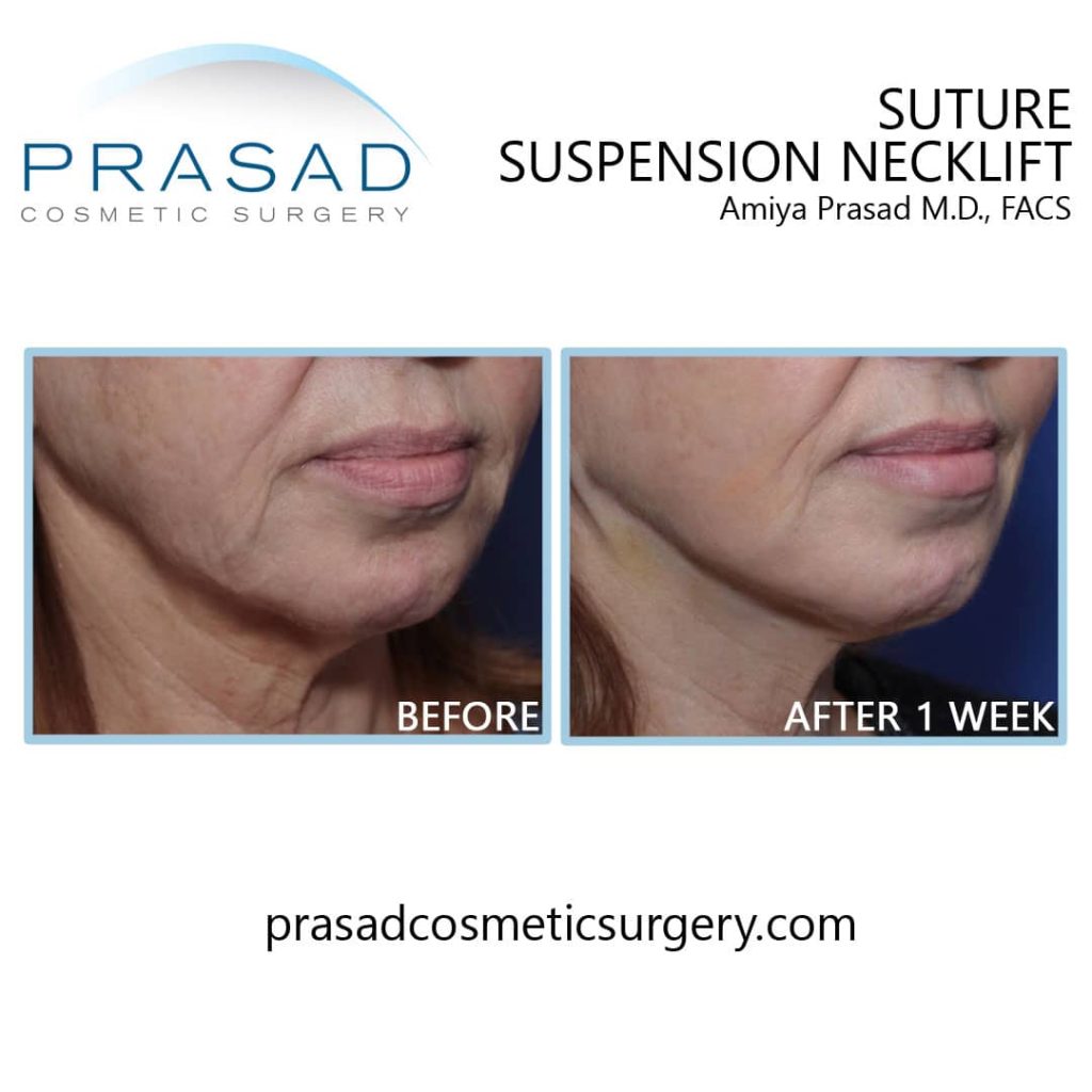 surgical neck lift before and after 1 week recovery