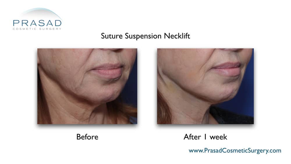 neck lift surgery before and after 1 week recovery