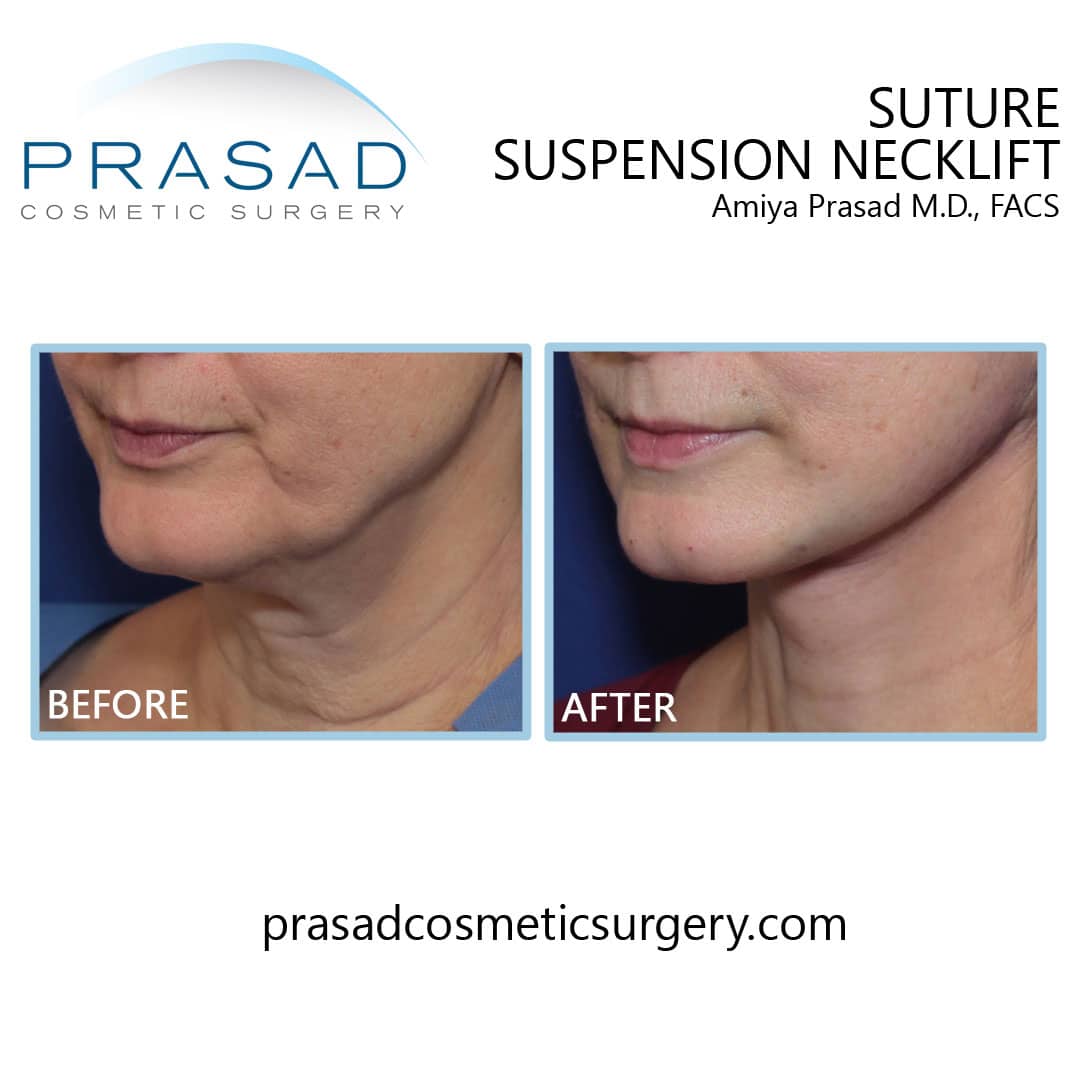 How To Choose The Best Neck Lift Procedure Dr Prasad Blog