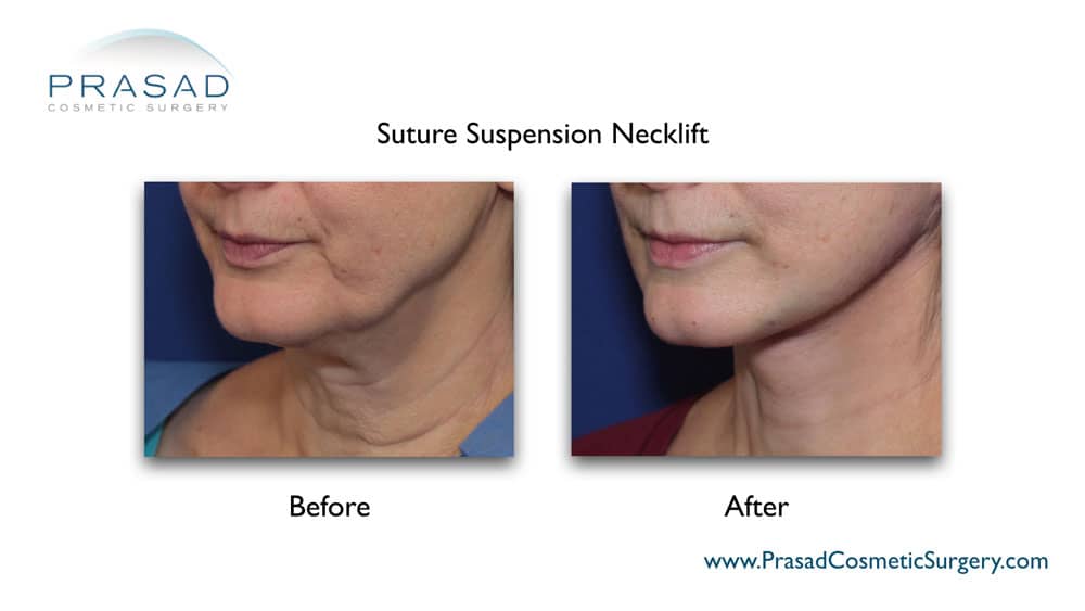 neck lift before and after photo procedure performed at Prasad Cosmetic Surgery Manhattan NYC