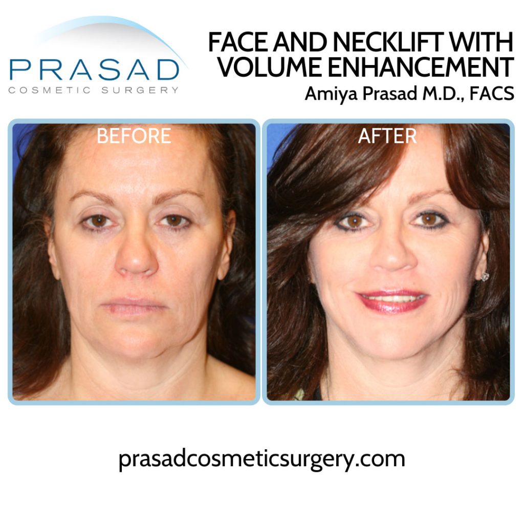 face and neck lift before and after complete recovery