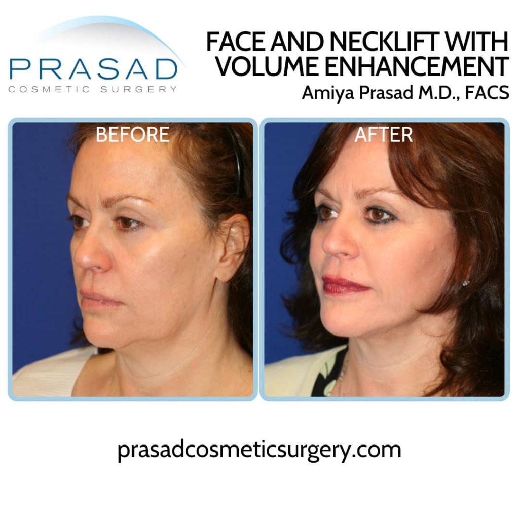 face and necklift before and after procedure done by Dr. Amiya Prasad, Manhattan NYC